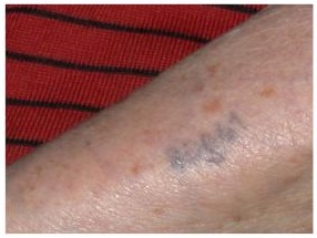 Auschwitz prisoner tattoo number — Edith Davidovici received matricule 80661